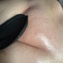 Dermaplaning