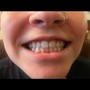 Teeth Whitening Follow Up