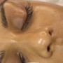 Adult Acne Facial