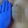 Microdermabrasion