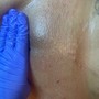 Microdermabrasion