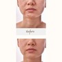 Acne Facial Dermabrasion