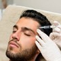 Acne Facial Dermabrasion