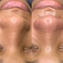 MicroNeedling