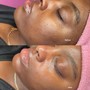 MicroNeedling