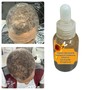 Scalp Treatment