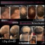 Hair Loss Correction Treatment (In Studio)