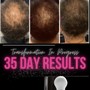 Hair Loss Correction - DIY