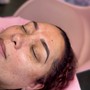 CHIN LIFT  + RF SKIN TIGHTENING