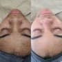 Oxygen Facial