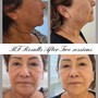 Cavi Slimming Treatment & RF Skin Tightening