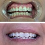 Teeth Whitening