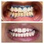 Teeth Whitening