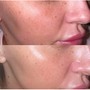 Microdermabrasion with Enzymatic Treatment