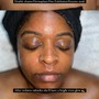 Blemish Diminish |Acne Facial