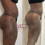 Laser Lipo + Lipo Cavitation + RF skin tightening