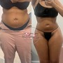 Cavitation + Laser Lipo