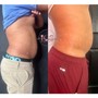 Cavitation + Laser Lipo