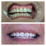 Teeth Whitening