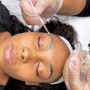 Microdermabrasion