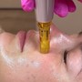 Black Head Removal