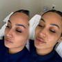 Oxygen Facial