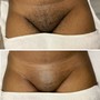 Men’s Chest Sugaring/ Wax