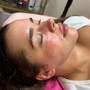 MicroNeedling & ChemPeel