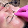 Dermaplaning