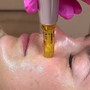 Black Head Removal