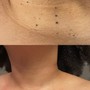 Microdermabrasion