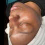 Oxygen Acne Facial