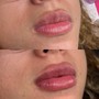 1ML Needleless Lip Fillers