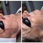 Dermaplaning Facial