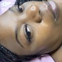 Acne Facial