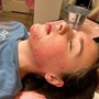 Acne Facial