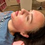 Acne Facial