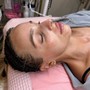 Chemical peel