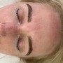 Glycolic Peel