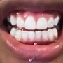 Thirty Minute Teeth Whitening Maintenance