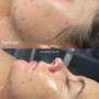 Acne Facial