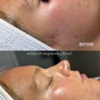 Chemical peel