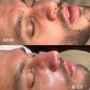 Oxygen Facial