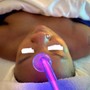 Teeth Whitening