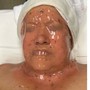 hydra Facial