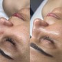 Dermaplaning with Custom Facial