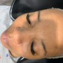 Scalp Treatment