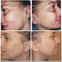 Jessner Chemical peel