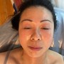 Microdermabrasion with Facial