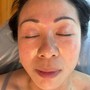 Microdermabrasion